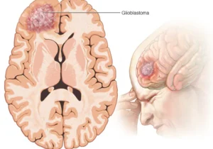 با هدف‌گیری اندوکان زندگی بیماران مبتلا به گلیوبلاستوما طولانی‌تر می‌شود